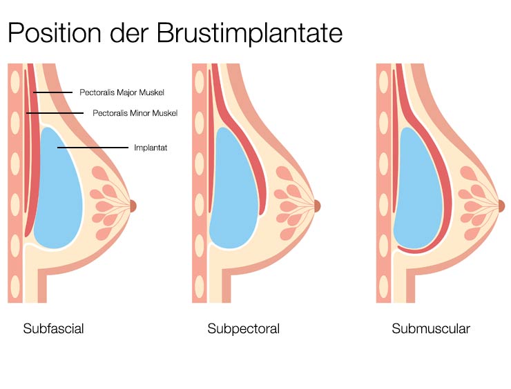 BII breast implant illness - Krank durch Brustimplantate · Dr. med. Christina Günter München