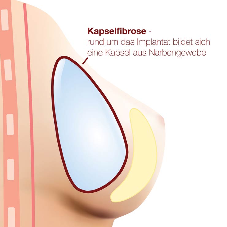 BII · Krank durch Brustimplantate · breast implant illness | Dr. med. Christina Günter München