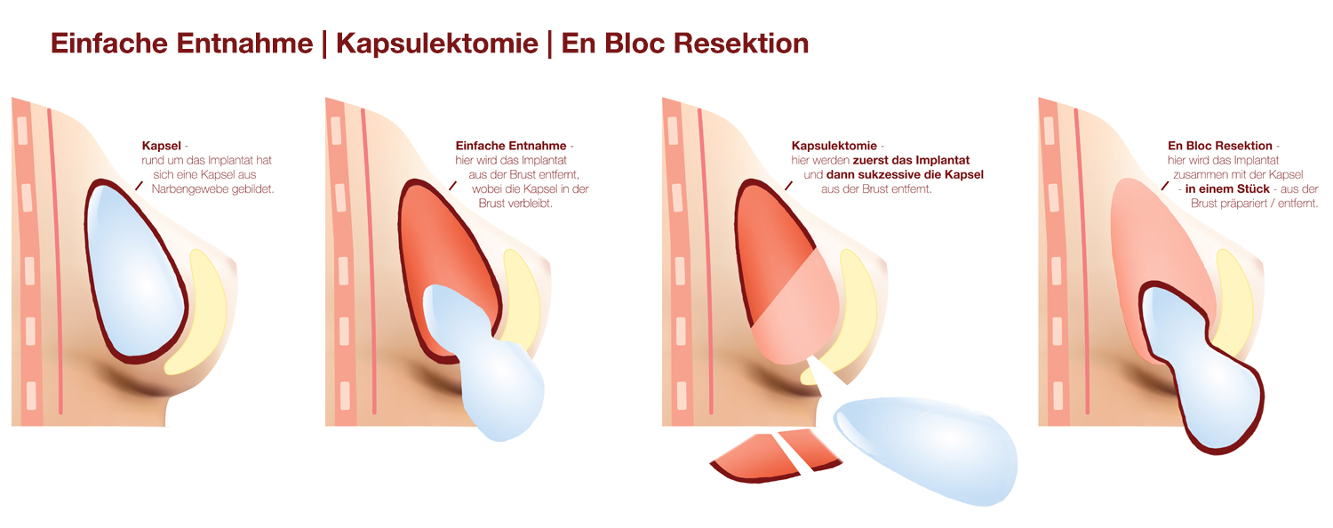 BII · Krank durch Brustimplantate · breast implant illness | Dr. med. Christina Günter München