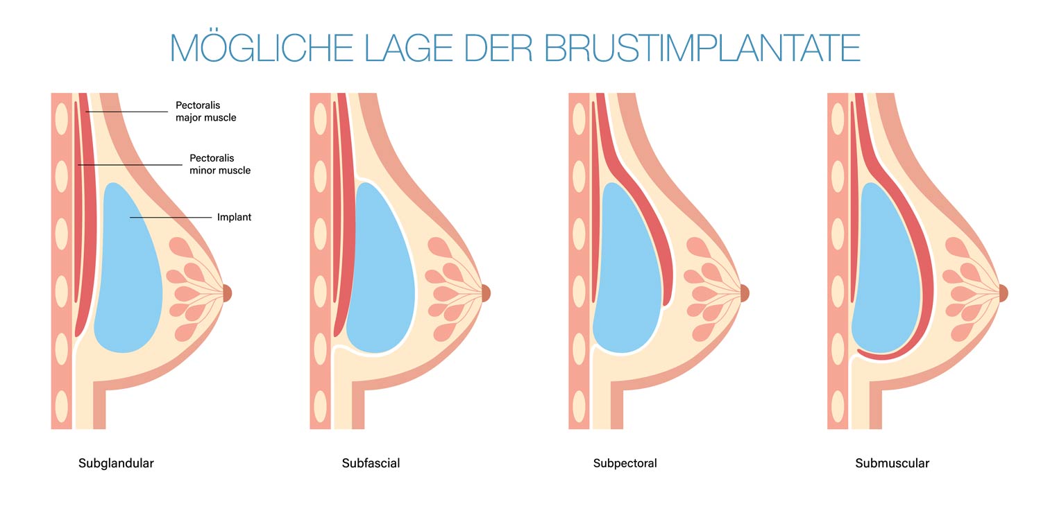 BII · Krank durch Brustimplantate · breast implant illness | Dr. med. Christina Günter München