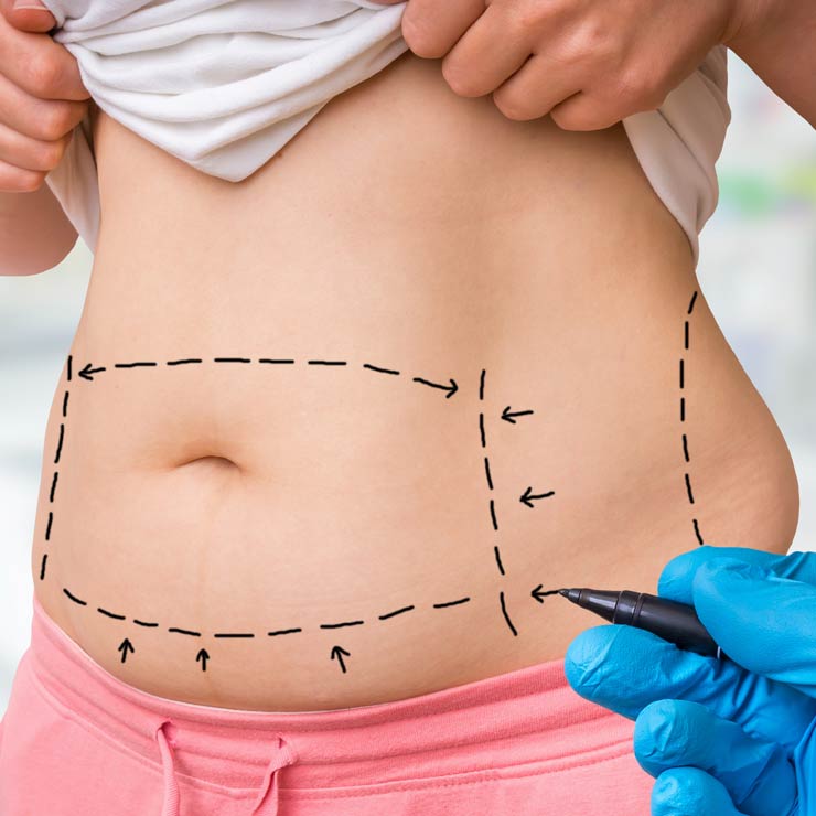 Mommy Makeover München - Mommymakeover, Bauchdeckenstraffung · Dr. med. Christina Günter